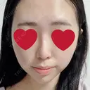 ヒアルロン酸注入（鼻） / ヒアルロン酸注入（あご） 新宿ビューティークリニック 新宿院 AFTER サムネイル用