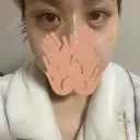 ヒアルロン酸注入（涙袋） フィラークリニック 新宿院 DAY 2 サムネイル用