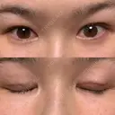 二重埋没 / 二重切開 宇都宮竹内クリニック DAY 25 サムネイル用