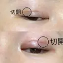 二重埋没 / 二重切開 宇都宮竹内クリニック DAY 25 サムネイル用