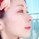 鼻尖形成（切開） / 鼻中隔延長（切開） / 軟骨移植 eクリニック 金沢本院 DAY 30 サムネイル用