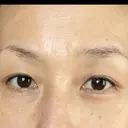 眼瞼下垂（切開） 湘南美容クリニック 秋葉原院 DAY 50 サムネイル用