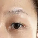 眼瞼下垂（切開） 湘南美容クリニック 秋葉原院 DAY 50 サムネイル用