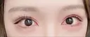 ヒアルロン酸注入（目の下） フィラークリニック 新宿院 DAY 0 サムネイル用
