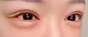 ヒアルロン酸注入（目の下） フィラークリニック 新宿院 AFTER サムネイル用
