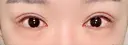 ヒアルロン酸注入（目の下） フィラークリニック 新宿院 DAY 1 サムネイル用