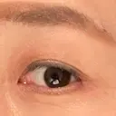 眼瞼下垂（切開） 湘南美容クリニック 秋葉原院 AFTER サムネイル用