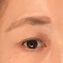 眼瞼下垂（切開） 湘南美容クリニック 秋葉原院 DAY 52 サムネイル用