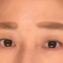 眼瞼下垂（切開） 湘南美容クリニック 秋葉原院 DAY 52 サムネイル用