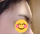 額を丸く / その他（輪郭） 品川美容外科 静岡院 DAY 69 サムネイル用