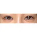 ヒアルロン酸注入（涙袋） / ヒアルロン酸注入（鼻） 柳津あおやま眼科クリニック AFTER サムネイル用