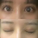 二重切開 / 上まぶたたるみ取り 酒井形成外科 DAY 17 サムネイル用