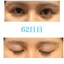 上まぶたの脂肪取り / 眉下切開 JUN CLINIC DAY 62 サムネイル用
