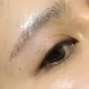 上まぶたの脂肪取り / 眉下切開 JUN CLINIC DAY 62 サムネイル用