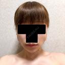 バッカルファット除去 / ボトックス（エラ・小顔） 湘南美容クリニック 金山院 DAY 5 サムネイル用
