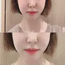 骨切り（あご） / 骨削り（エラ） / 骨削り（頬） id（アイディ）美容外科 DAY 307 サムネイル用
