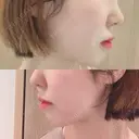 骨切り（あご） / 骨削り（エラ） / 骨削り（頬） id（アイディ）美容外科 DAY 307 サムネイル用