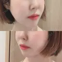 骨切り（あご） / 骨削り（エラ） / 骨削り（頬） id（アイディ）美容外科 DAY 307 サムネイル用