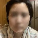 ボトックス（エラ・小顔） 湘南美容クリニック 名古屋院 DAY 7 サムネイル用