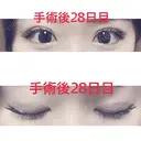 二重埋没 湘南美容クリニック 松山院 DAY 28 サムネイル用