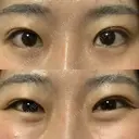 蒙古ひだ形成 R.O.clinic AFTER サムネイル用