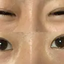 蒙古ひだ形成 R.O.clinic DAY 60 サムネイル用