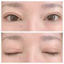 二重切開 北尾クリニック DAY 33 サムネイル用