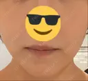 シミ取りレーザー / YAGレーザー PICO BEAUTY CLINIC DAY 9 サムネイル用