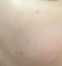 シミ取りレーザー / YAGレーザー PICO BEAUTY CLINIC AFTER サムネイル用