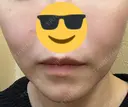シミ取りレーザー / YAGレーザー PICO BEAUTY CLINIC DAY 15 サムネイル用
