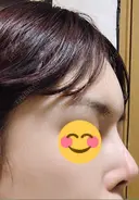 額を丸く / その他（輪郭） 品川美容外科 静岡院 DAY 72 サムネイル用
