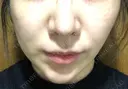 糸リフト ノーチェビューティクリニック DAY 9 サムネイル用