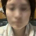 ボトックス（エラ・小顔） 湘南美容クリニック 名古屋院 DAY 9 サムネイル用