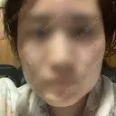 ボトックス（エラ・小顔） 湘南美容クリニック 名古屋院 AFTER サムネイル用