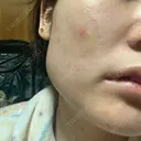 ボトックス（エラ・小顔） 湘南美容クリニック 名古屋院 DAY 10 サムネイル用