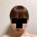 バッカルファット除去 / ボトックス（エラ・小顔） 湘南美容クリニック 金山院 DAY 6 サムネイル用