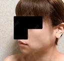 バッカルファット除去 / ボトックス（エラ・小顔） 湘南美容クリニック 金山院 DAY 7 サムネイル用