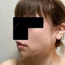 バッカルファット除去 / ボトックス（エラ・小顔） 湘南美容クリニック 金山院 DAY 5 サムネイル用