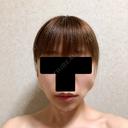 バッカルファット除去 / ボトックス（エラ・小顔） 湘南美容クリニック 金山院 DAY 6 サムネイル用
