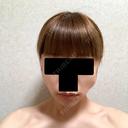バッカルファット除去 / ボトックス（エラ・小顔） 湘南美容クリニック 金山院 DAY 7 サムネイル用