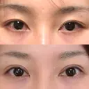 二重切開 / 眼瞼下垂（切開） / 上まぶたたるみ取り 湘南美容クリニック 新宿南口院 DAY 193 サムネイル用