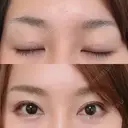 二重切開 / 眼瞼下垂（切開） / 上まぶたたるみ取り 湘南美容クリニック 新宿南口院 DAY 193 サムネイル用