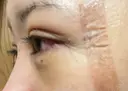 二重埋没 / 目頭切開 / 目尻切開 / タレ目形成・グラマラスライン（切開） HAAB×DREAM BEAUTY CLINIC 東京本院 DAY 4 サムネイル用