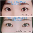 二重埋没 / 目頭切開 目白ポセンシアクリニック DAY 11 サムネイル用