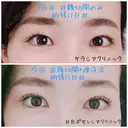 二重埋没 / 目頭切開 目白ポセンシアクリニック DAY 11 サムネイル用