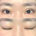 二重切開 / 上まぶたの脂肪取り 松下皮フ形成外科 DAY 14 サムネイル用