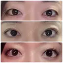 二重埋没 水の森美容クリニック 東京銀座院 AFTER サムネイル用