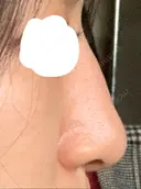 隆鼻術 アネシス美容クリニック DAY 20 サムネイル用