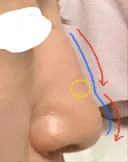 隆鼻術 アネシス美容クリニック DAY 44 サムネイル用