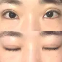二重切開 / 上まぶたの脂肪取り 松下皮フ形成外科 DAY 15 サムネイル用